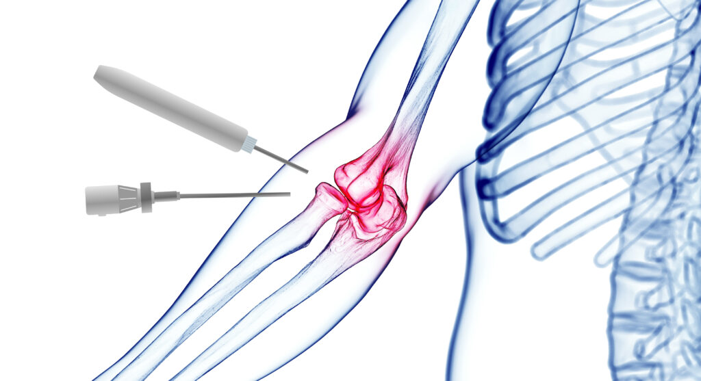 Αρθροσκόπηση Αγκώνα