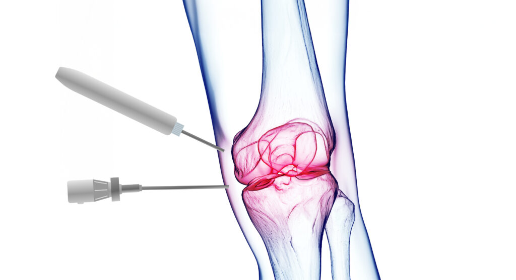 αρθροσκόπηση γόνατος