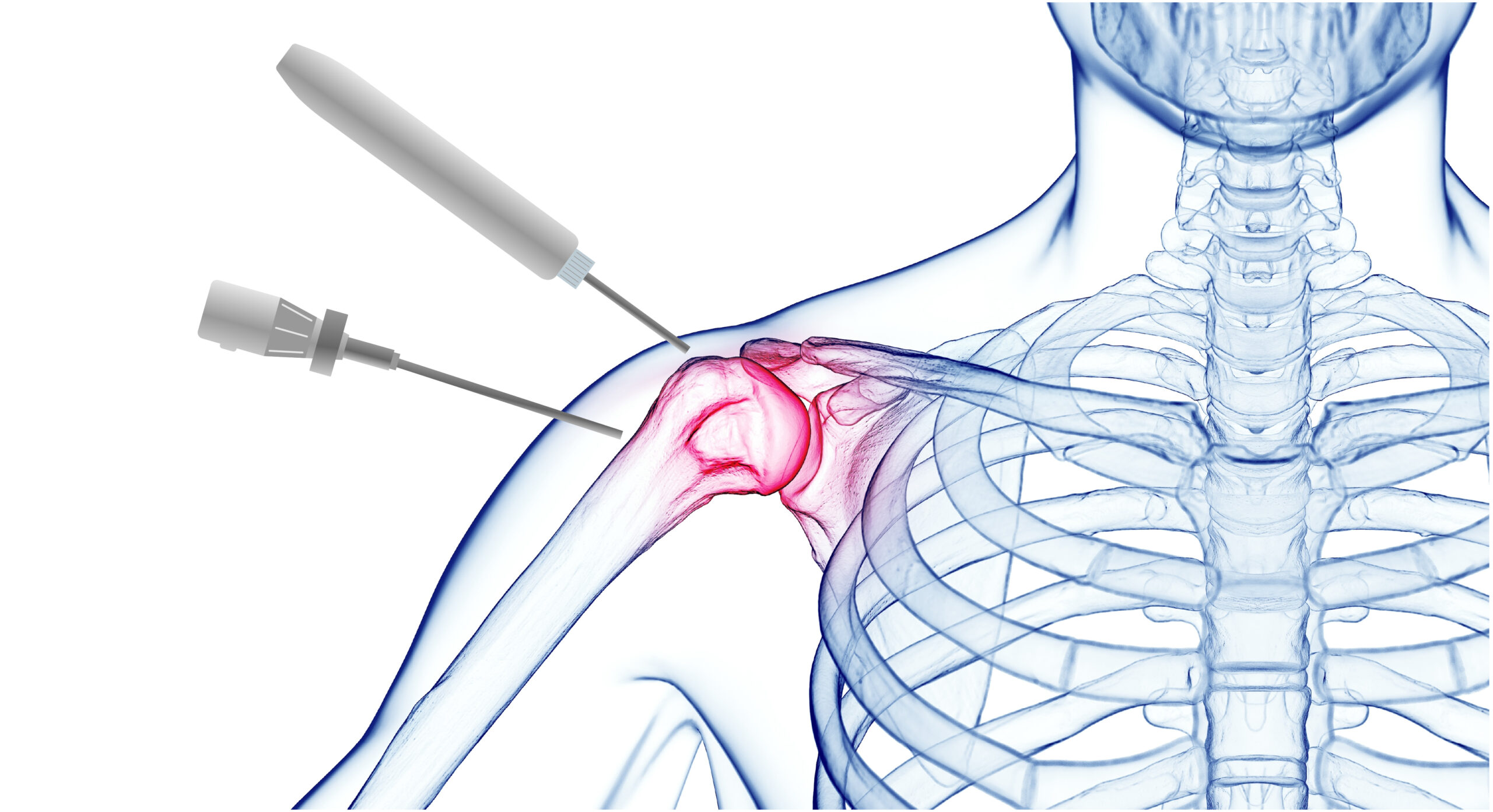 Αρθροσκόπηση Ώμου