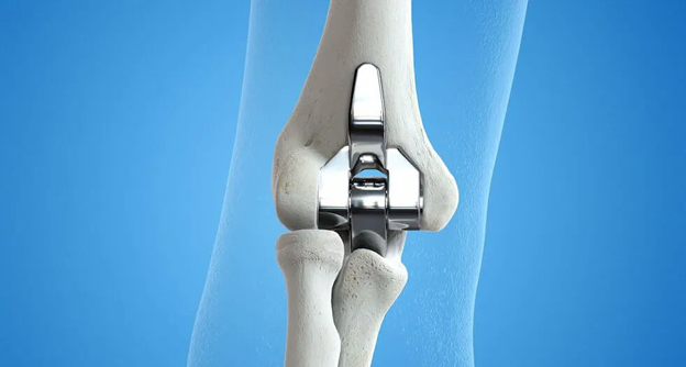 Αρθροπλαστική Αγκώνα