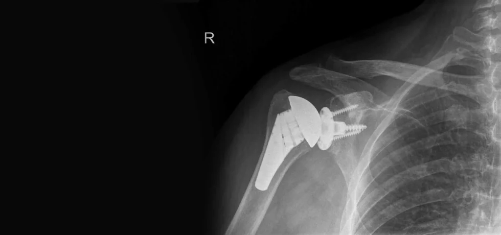 ολική αρθροπλαστική ώμου