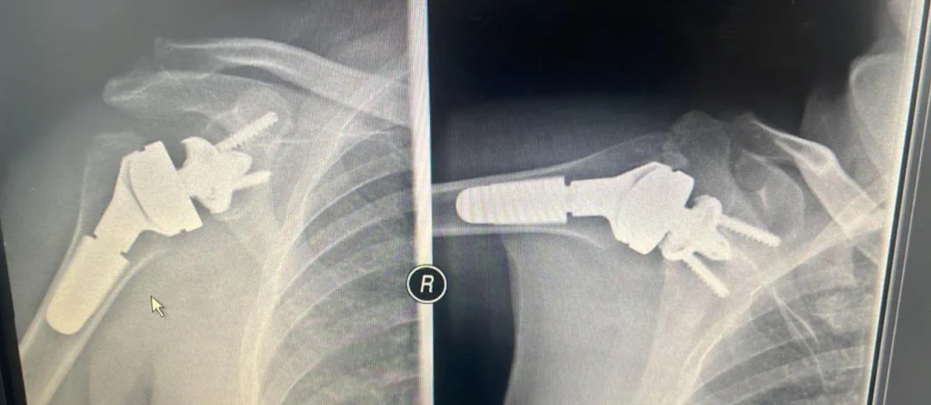 Εξατομικευμένη Ανάστροφη Ολική Αρθροπλαστική Δεξιού Ώμου σε Ασθενή με Βαριά Παραμορφωτική Αρθρίτιδα