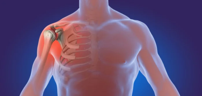 αρθρίτιδα ώμου τι πρέπει να κάνετε